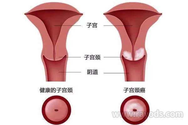 昆明什么叫做代孕,做完试管婴儿移植后宫颈头不光滑了_上海供卵试管生子多少
