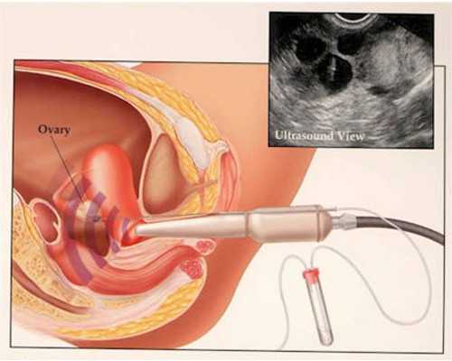 昆明试管捐卵生子有偿捐卵平台婴儿花费明细表