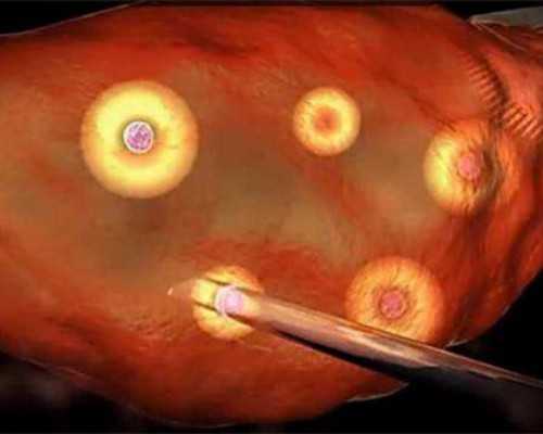 昆明协和医院取卵打麻药吗?疼不疼?,昆明协和医院借卵生男孩单周期费用3万